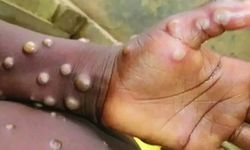 Maymun çiçeği virüsü nedir ve nasıl bulaşır?